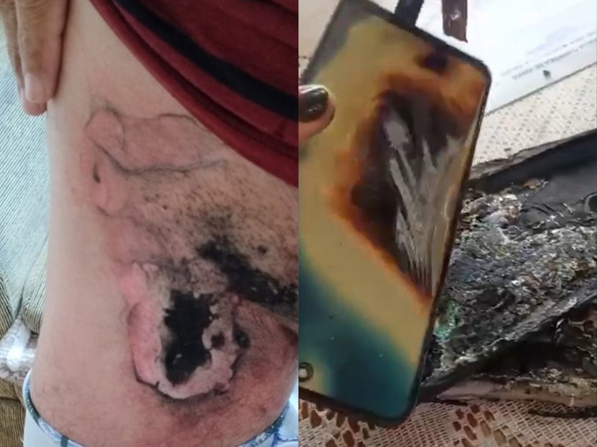 Celular explode e deixa homem com queimaduras em Avaré 1 celular explode e deixa homem com queimaduras em avare