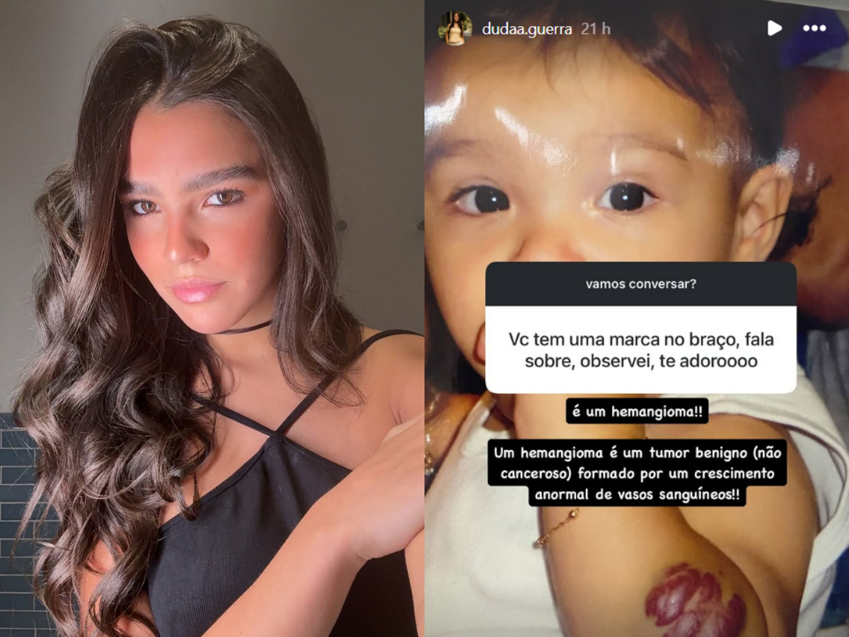 Hemangiomas: tumor benigno de Duda Guerra explicado por especialista 1 hemangiomas tumor benigno de duda guerra explicado por especialista