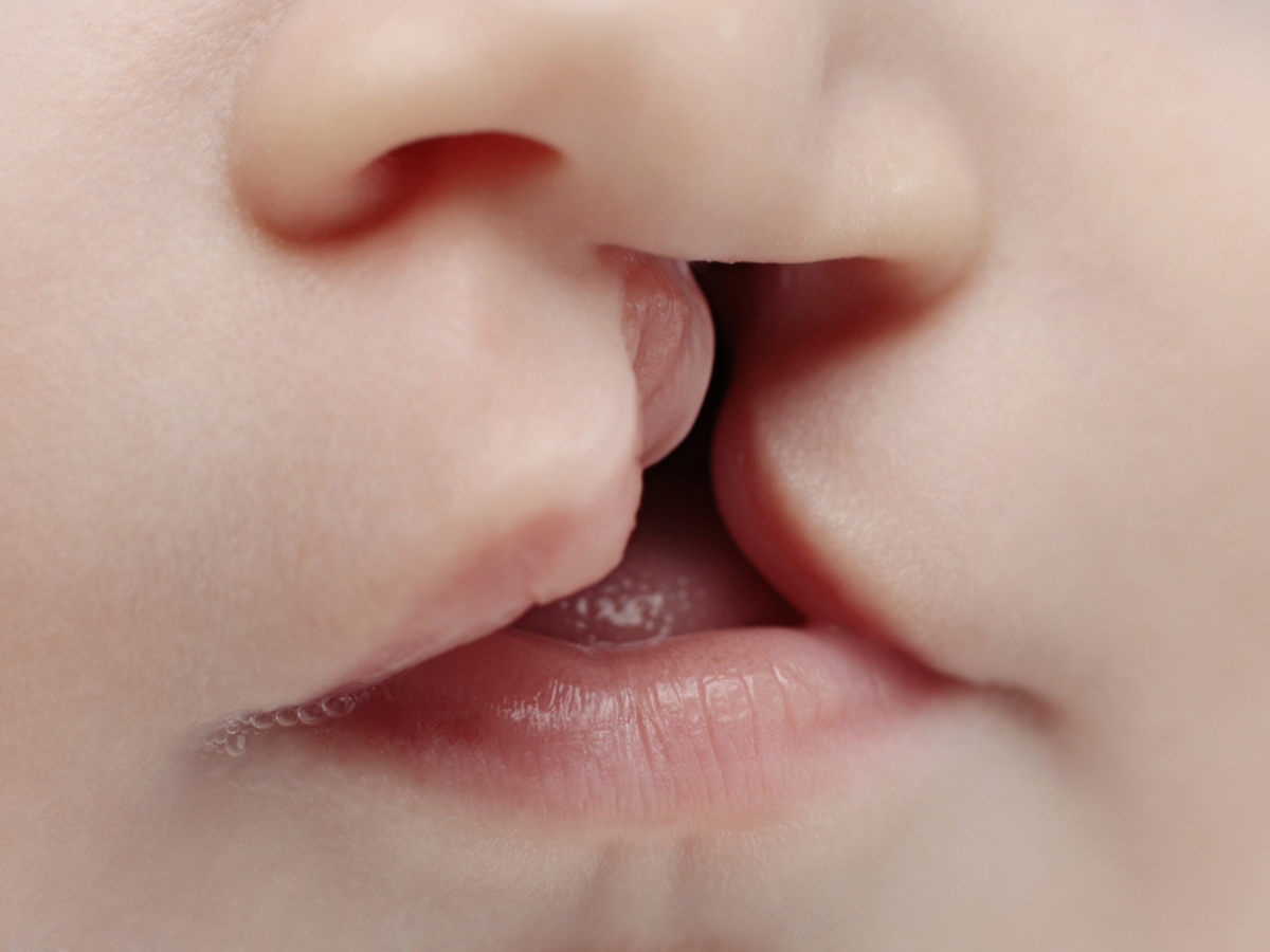 Fissura Labiopalatina: Causas e Tratamentos Explicados 1 fissura labiopalatina causas e tratamentos