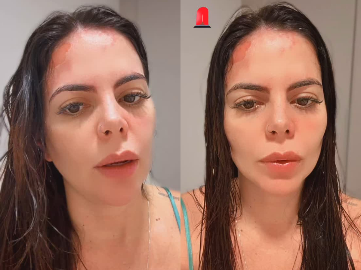 gravida excasamento as cegas sofre grave acidente e exibe queimaduras