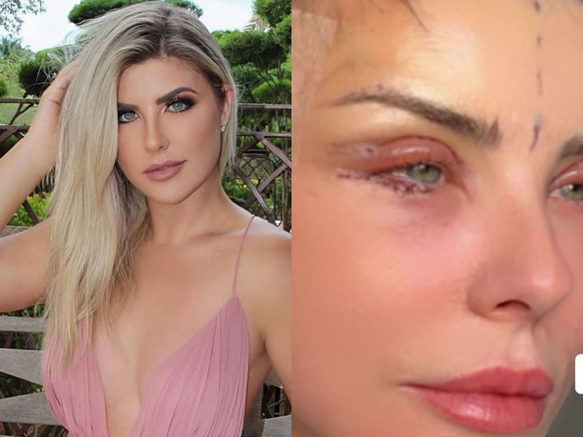 Íris Stefanelli revela transformação facial após cirurgia 1 iris stefanelli revela transformacao facial apos cirurgia