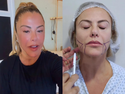 Poliana Rocha passa por procedimentos estéticos no rosto e fala sobre recuperação