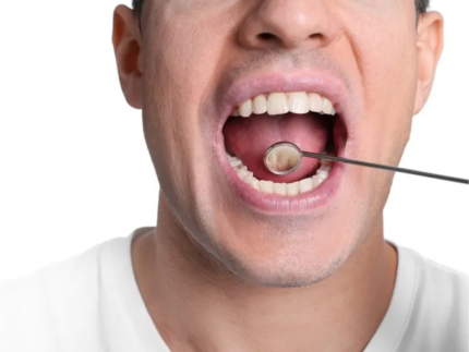 Fatores de risco e prevenção do câncer bucal: tudo que você precisa saber